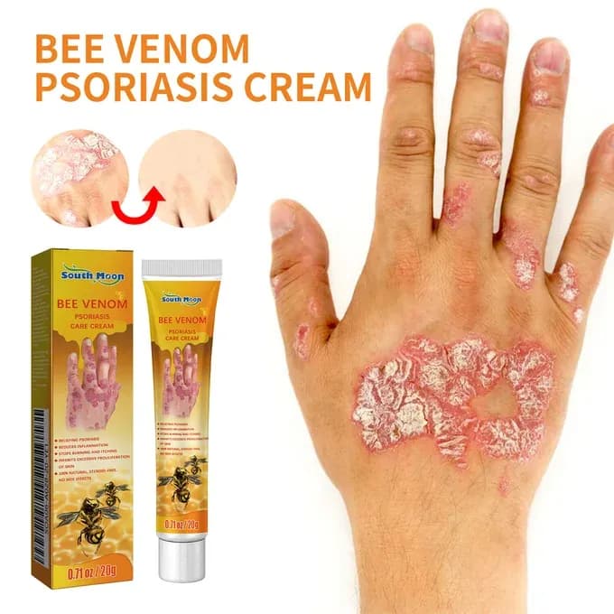 psoriasis crème